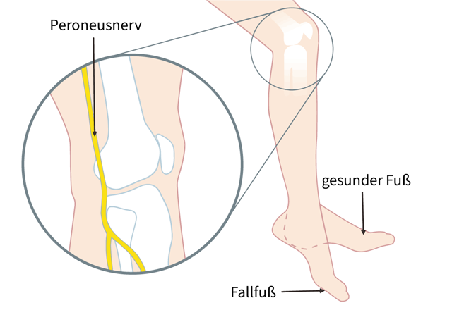 Schaubild eines Beins mit Darstellung des Peroneusnervs und Vergleich zwischen gesundem Fuß und Fallfuß bei Peroneusparese.